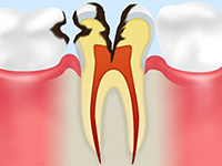 C3（神経の虫歯）