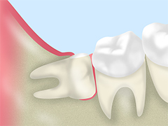 奥歯が痛いのは、親知らずが原因かもしれません