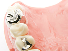 銀歯を治療に用いるリスク