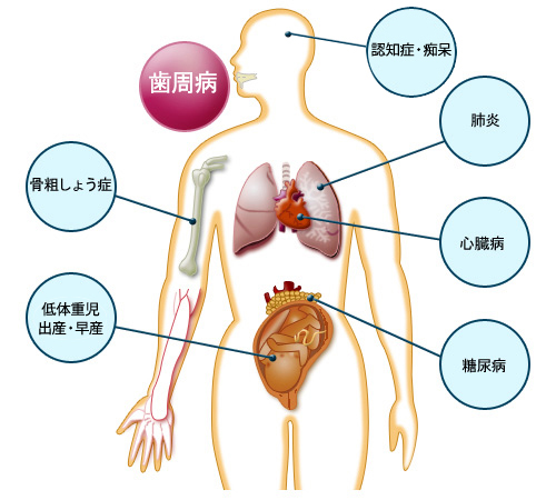 歯周病と関連のある全身疾患（一例）