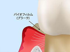 軽度歯周炎の場合