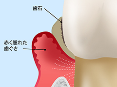 中等度歯周炎の場合