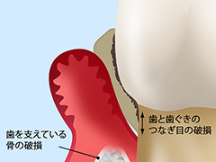 重度歯周炎の場合